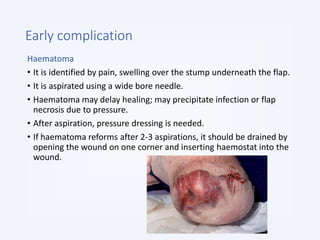Early complication
Haematoma
• It is identified by pain, swelling over the stump underneath the flap.
• It is aspirated using a wide bore needle.
• Haematoma may delay healing; may precipitate infection or flap
necrosis due to pressure.
• After aspiration, pressure dressing is needed.
• If haematoma reforms after 2-3 aspirations, it should be drained by
opening the wound on one corner and inserting haemostat into the
wound.
 