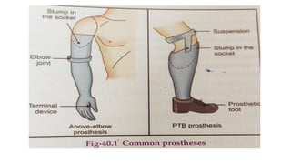 Amputation and Prosthesis | PPTX