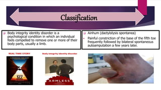 Amputation and prosthesis | PPTX