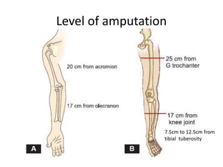 Level of amputation
7.5cm to 12.5cm from
tibial tuberosity
 