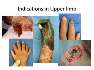 Indications in Upper limb
 