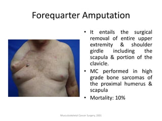 Forequarter Amputation
• It entails the surgical
removal of entire upper
extremity & shoulder
girdle including the
scapula & portion of the
clavicle.
• MC performed in high
grade bone sarcomas of
the proximal humerus &
scapula
• Mortality: 10%
Musculoskeletal Cancer Surgery, 2001
 