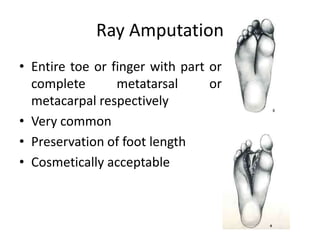 Ray Amputation
• Entire toe or finger with part or
complete metatarsal or
metacarpal respectively
• Very common
• Preservation of foot length
• Cosmetically acceptable
 