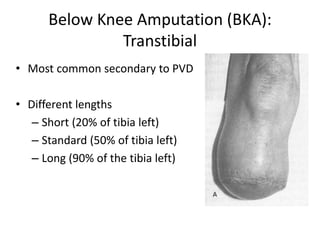 Below Knee Amputation (BKA):
Transtibial
• Most common secondary to PVD
• Different lengths
– Short (20% of tibia left)
– Standard (50% of tibia left)
– Long (90% of the tibia left)
 
