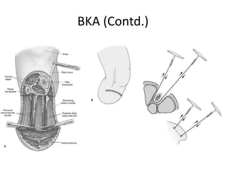 BKA (Contd.)
 