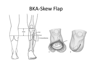 BKA-Skew Flap
 