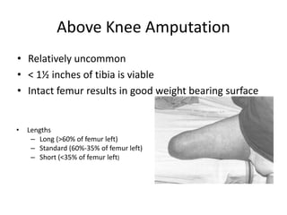 Above Knee Amputation
• Relatively uncommon
• < 1½ inches of tibia is viable
• Intact femur results in good weight bearing surface
• Lengths
– Long (>60% of femur left)
– Standard (60%-35% of femur left)
– Short (<35% of femur left)
 