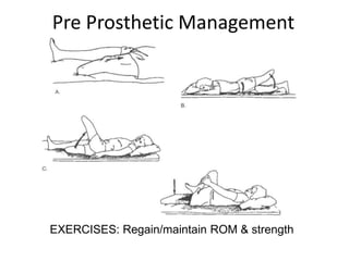Pre Prosthetic Management
EXERCISES: Regain/maintain ROM & strength
 