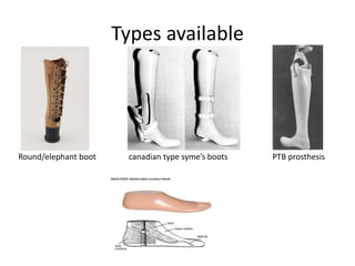 Types available
Round/elephant boot canadian type syme’s boots PTB prosthesis
 