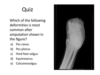 Quiz
Which of the following
deformities is most
common after
amputation shown in
the figure?
a) Pes cavus
b) Pes planus
c) Hind foot valgus
d) Equinovarus
e) Calcaneovalgus
 