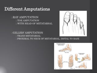 Amputations | PPTX