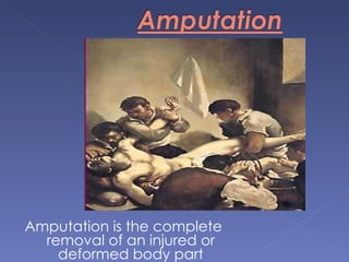 Amputation is the complete removal of an injured or deformed body part 