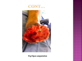 Fig:Open amputation
 