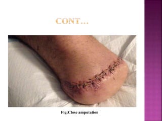 Fig:Close amputation
 
