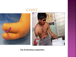 Fig: Krukenburg amputation
 