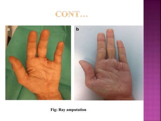 Fig: Ray amputation
 