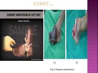 Fig: Chopart amputation
 