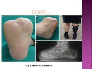 Fig: Lisfranc’s amputation
 