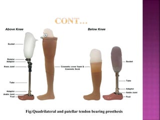 Fig:Quadrilateral and patellar tendon bearing prosthesis
 