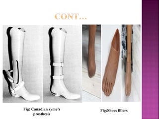 Fig: Canadian syme’s
prosthesis
Fig:Shoes fillers
 
