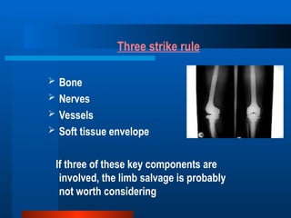 Advancements in Limb Salvage Surgery for Malignant Bone Tumors ...