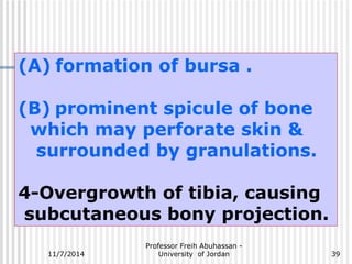 (A) formation of bursa . 
(B) prominent spicule of bone 
which may perforate skin & 
surrounded by granulations. 
4-Overgrowth of tibia, causing 
subcutaneous bony projection. 
Professor Freih Abuhassan - 
11/7/2014 University of Jordan 
39 
 