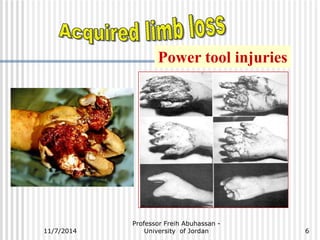 Power tool injuries 
Professor Freih Abuhassan - 
11/7/2014 University of Jordan 
6 
 