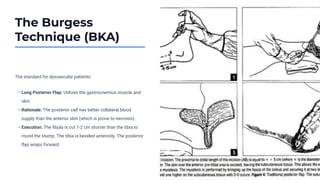 The Burgess
Technique (BKA)
The standard for dysvascular patients.
• Long Posterior Flap: Utilizes the gastrocnemius muscle and
skin.
• Rationale: The posterior calf has better collateral blood
supply than the anterior skin (which is prone to necrosis).
• Execution: The ﬁbula is cut 1-2 cm shorter than the tibia to
round the stump. The tibia is beveled anteriorly. The posterior
ﬂap wraps forward.
 