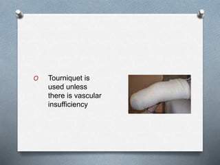 O Tourniquet is
used unless
there is vascular
insufficiency
 