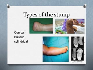Types of the stump
Conical
Bullous
cylindrical
 