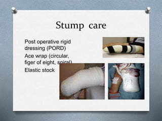 Stump care
Post operative rigid
dressing (PORD)
Ace wrap (circular,
figer of eight, spiral)
Elastic stock
 