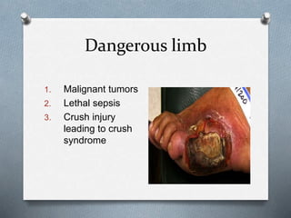 Dangerous limb
1. Malignant tumors
2. Lethal sepsis
3. Crush injury
leading to crush
syndrome
 