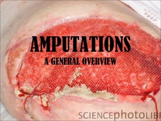 AMPUTATIONS
A GENERAL OVERVIEW
 