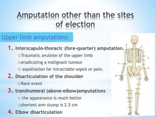1. Interscapulo-thoracic (fore-quarter) amputation.
oTraumatic avulsion of the upper limb
oeradicating a malignant tumour
o aspalliation for intractable sepsis or pain.
2. Disarticulation of the shoulder
oRare event
3. transhumeral (above-elbow)amputations
o the appearance is much better
oshortest arm stump is 2.5 cm
4. Elbow disarticulation
Upper limb amputations:
 