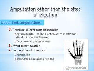 5. Transradial (forearm) amputation
ooptimal length is at the junction of the middle and
distal thirds of the forearm
oBoth bones cut in same level
6. Wrist disarticulation
7. Amputations in the hand
oPolydactyly
oTraumatic amputation of fingers
Upper limb amputations:
 