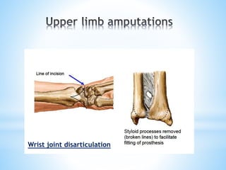 Wrist joint disarticulation
 