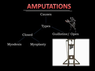 Guillotine/ OpenClosed
Causes
Types
Myodesis Myoplasty
 