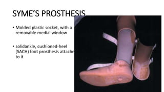 SYME’S PROSTHESIS
• Molded plastic socket, with a
removable medial window
• solidankle, cushioned-heel
(SACH) foot prosthesis attached
to it
 
