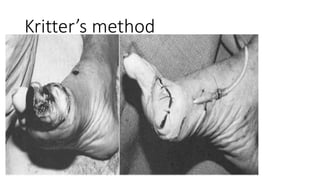 Kritter’s method
 