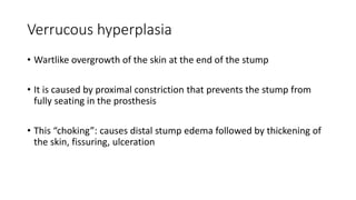 Verrucous hyperplasia
• Wartlike overgrowth of the skin at the end of the stump
• It is caused by proximal constriction that prevents the stump from
fully seating in the prosthesis
• This “choking”: causes distal stump edema followed by thickening of
the skin, fissuring, ulceration
 