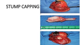 STUMP CAPPING PROCEDURE
 