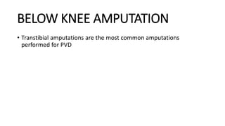BELOW KNEE AMPUTATION
• Transtibial amputations are the most common amputations
performed for PVD
 
