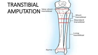 TRANSTIBIAL
AMPUTATION –
 