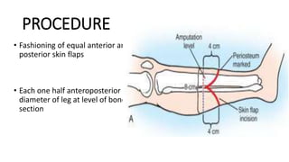 PROCEDURE
• Fashioning of equal anterior and
posterior skin flaps
• Each one half anteroposterior
diameter of leg at level of bone
section
 