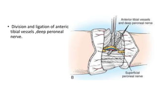 • Division and ligation of anterior
tibial vessels ,deep peroneal
nerve.
 