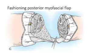 Fashioning posterior myofascial flap
 