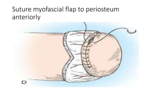 Suture myofascial flap to periosteum
anteriorly
 