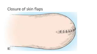 Closure of skin flaps
 