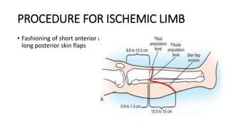 PROCEDURE FOR ISCHEMIC LIMB
• Fashioning of short anterior and
long posterior skin flaps
 
