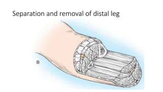 Separation and removal of distal leg
 